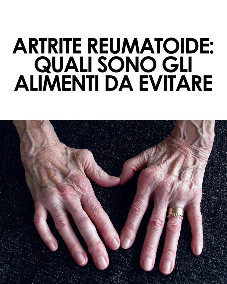 Come si vive con l’artrite reumatoide? Le difficoltà che si devono affrontare