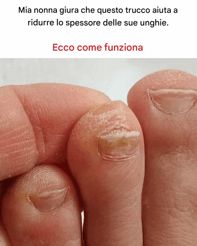 Unghie dei Piedi Ispessite? Ecco il Rimedio Naturale per Ridurne lo Spessore